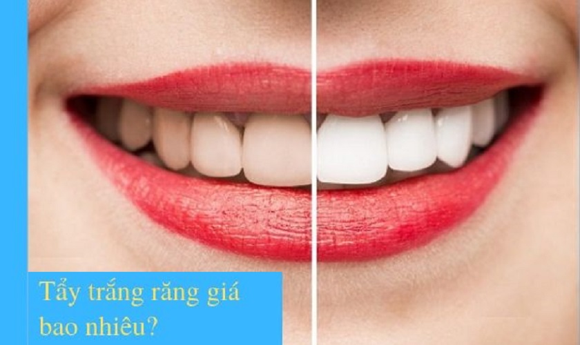 Tẩy trắng răng giá bao nhiêu tại Nha khoa Nhân Tâm?